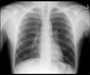 Chest x-ray